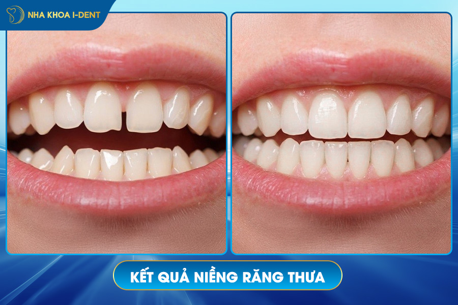 kết quả niềng răng thưa