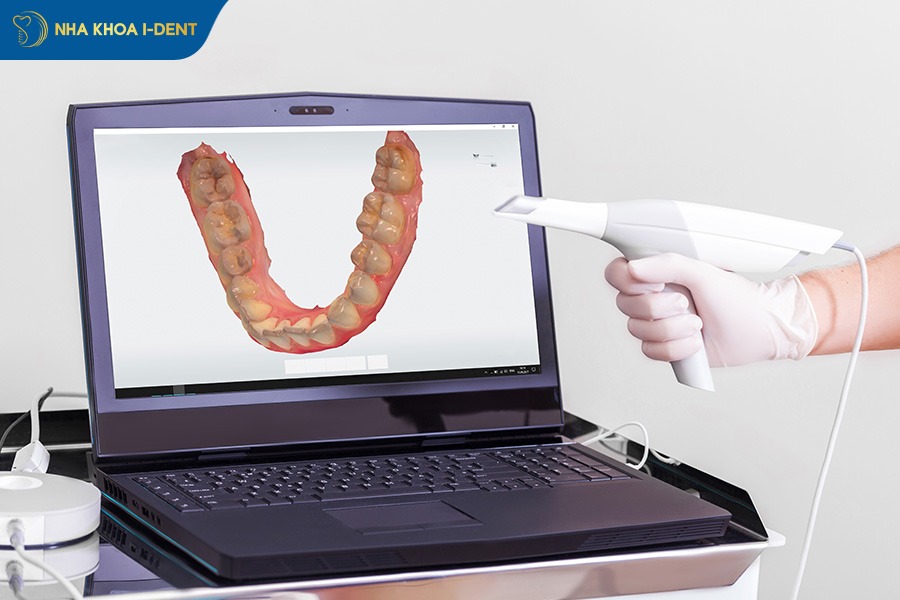 Khay niềng ecligner được thiết kế cá nhân hóa