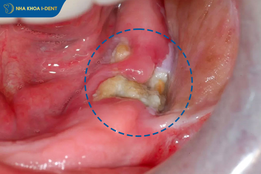 Khi nào nhổ răng khôn
