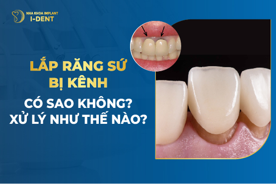 Lắp Răng Sứ Bị Kênh Có Sao Không? Xử Lý Như Thế Nào?