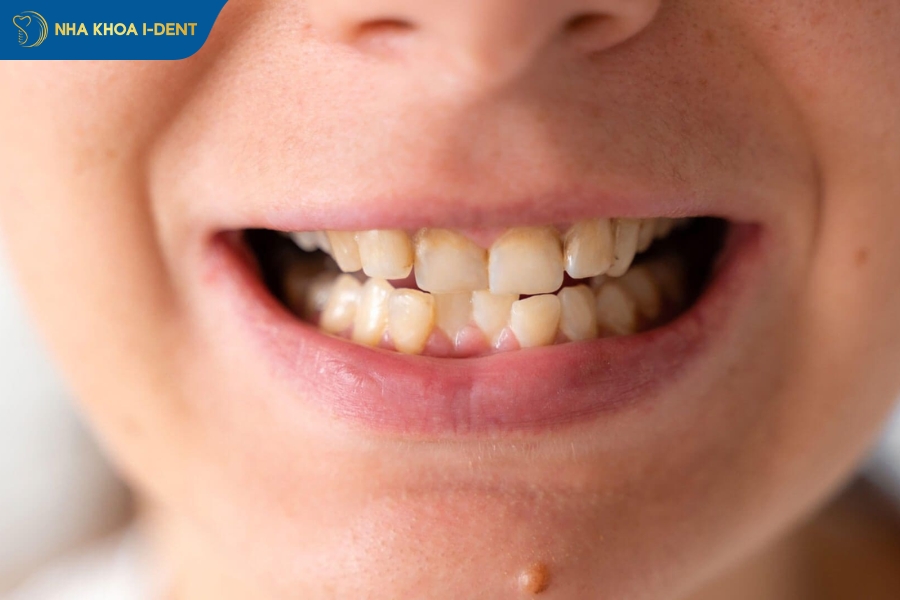 lợi ích của việc niềng răng
