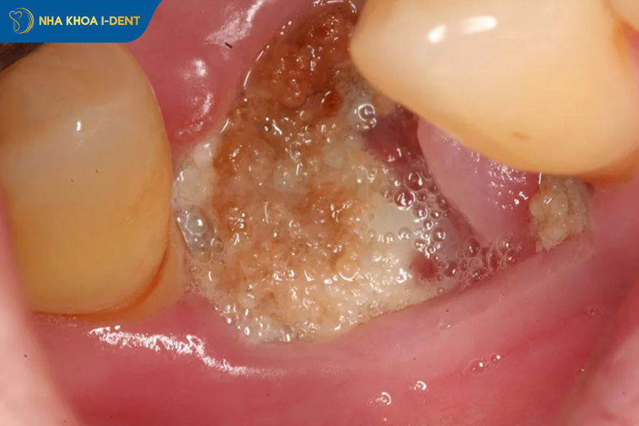 lớp màng trắng sau nhổ răng