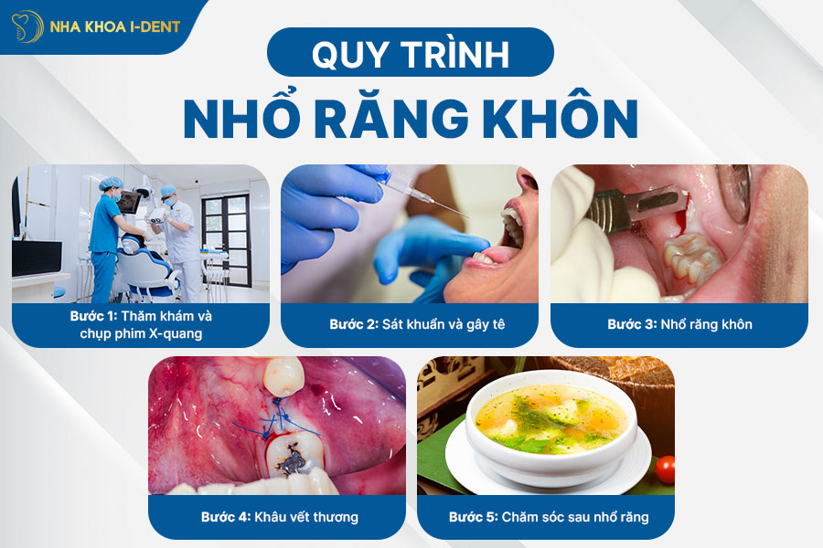 lúc nào nên nhổ răng khôn