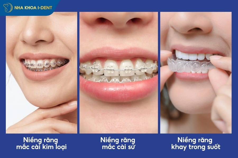 lưu ý khi niềng răng