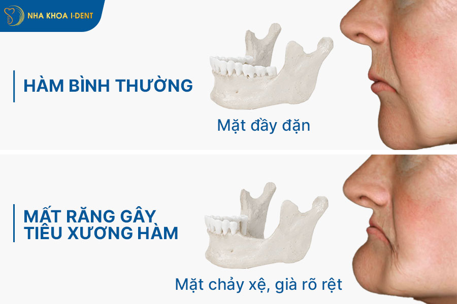 mất răng bao lâu thì bị tiêu xương