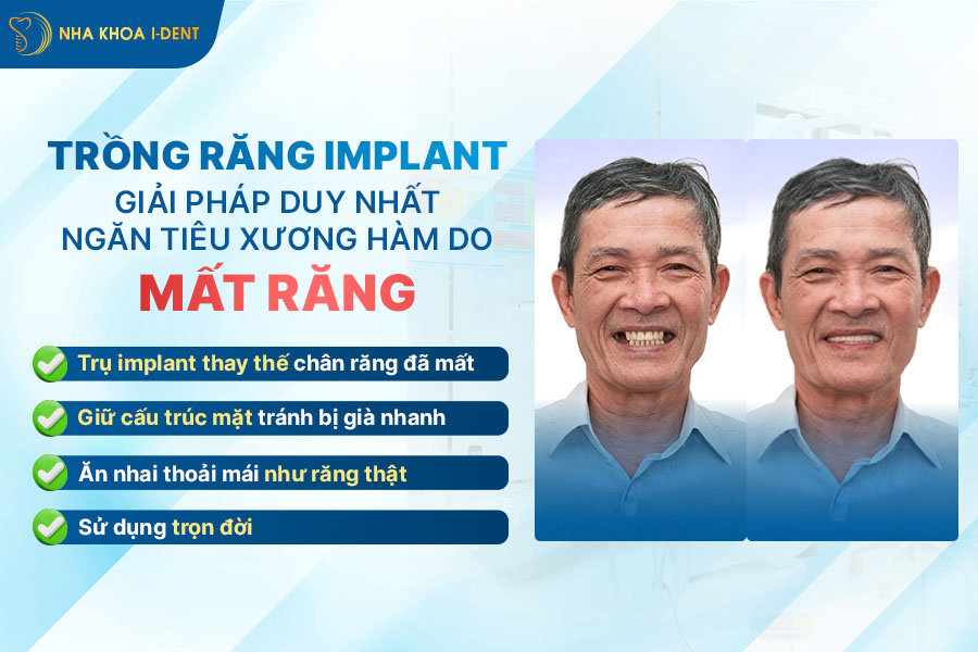 mất răng bao lâu thì tiêu xương