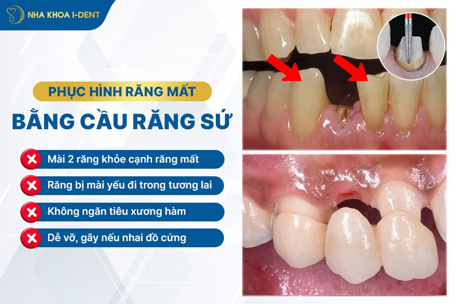 mất răng hàm có sao không