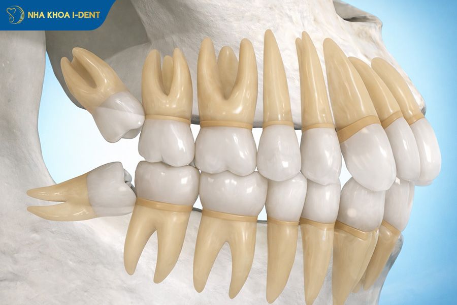 nên nhổ răng khôn khi nào