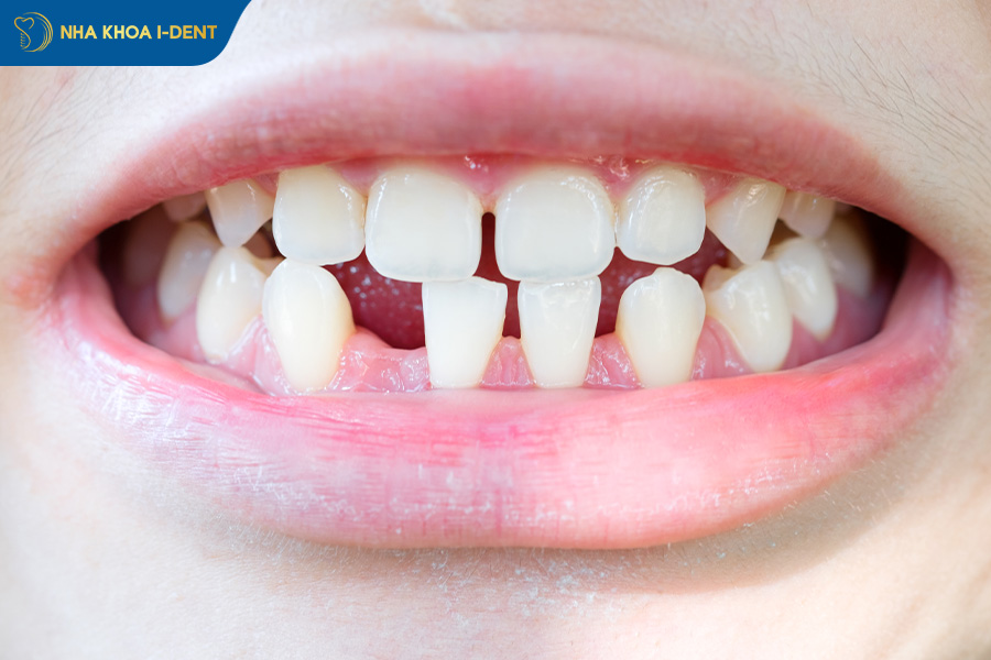 nên niềng răng hay bọc sứ