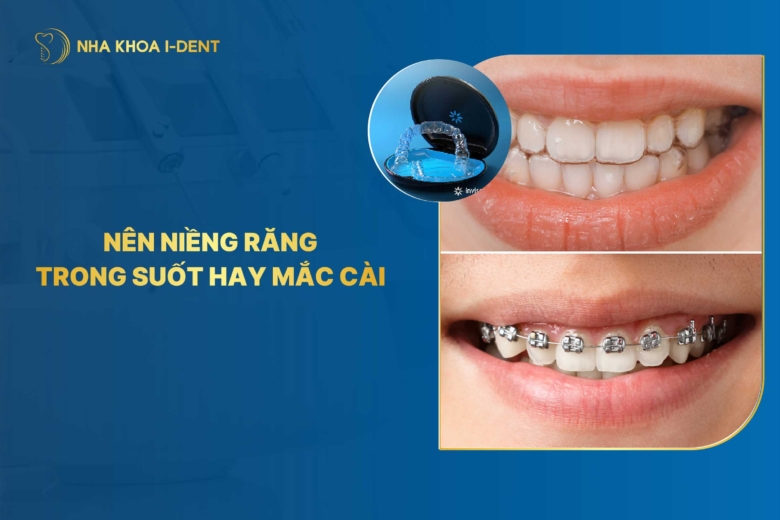 Nên niềng răng trong suốt hay mắc cài? Loại nào tốt?