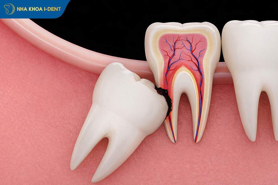 nếu không nhổ răng khôn thì sao