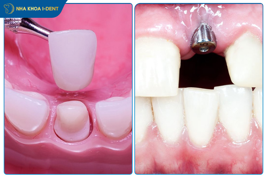 người đã bọc răng sứ hoặc trồng implant toàn hàm