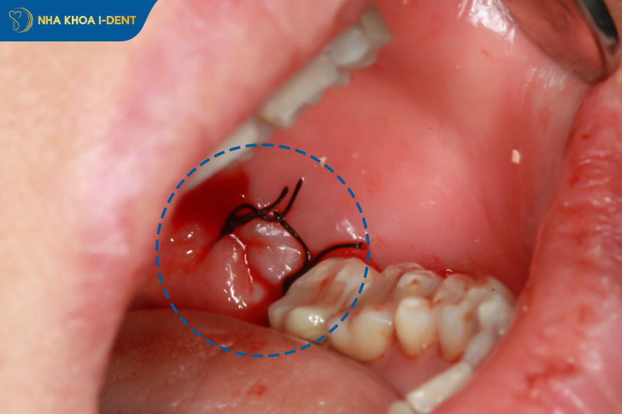 nhổ răng bao lâu hết chảy máu