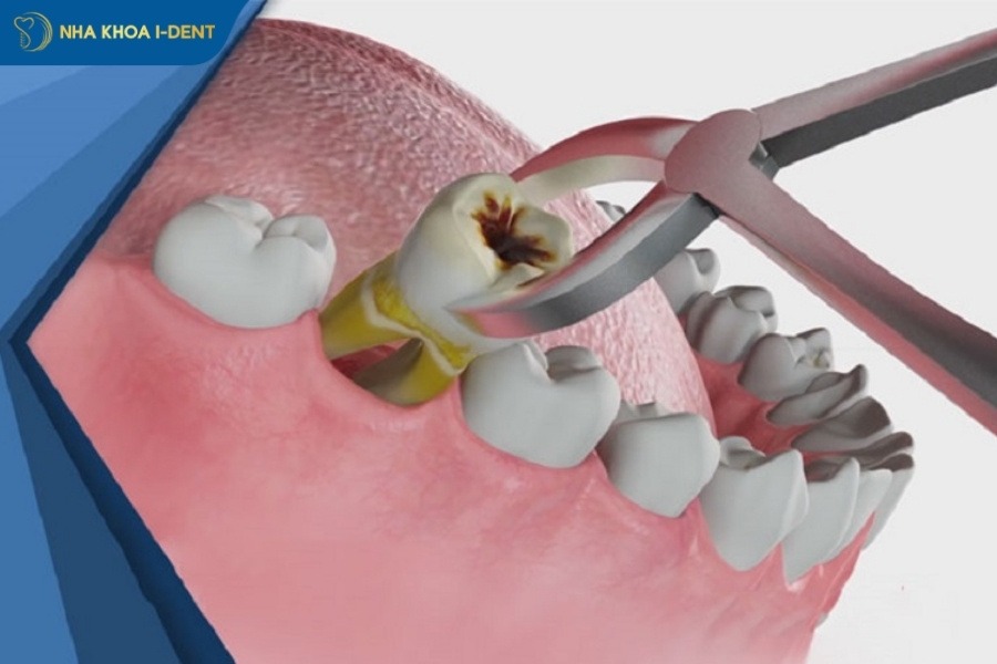 nhổ răng cấm bị sâu có ảnh hưởng gì không
