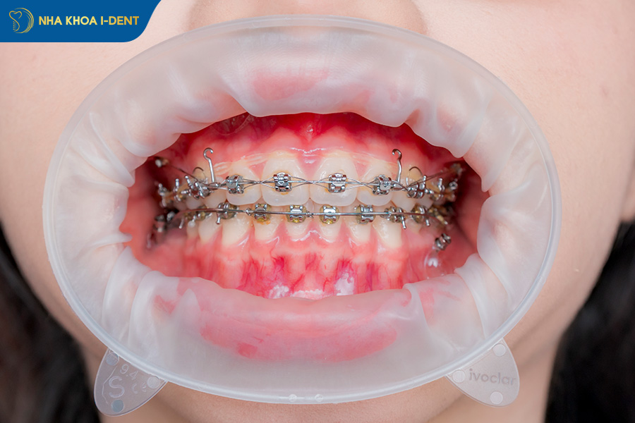 nhổ răng có ảnh hưởng đến thần kinh không