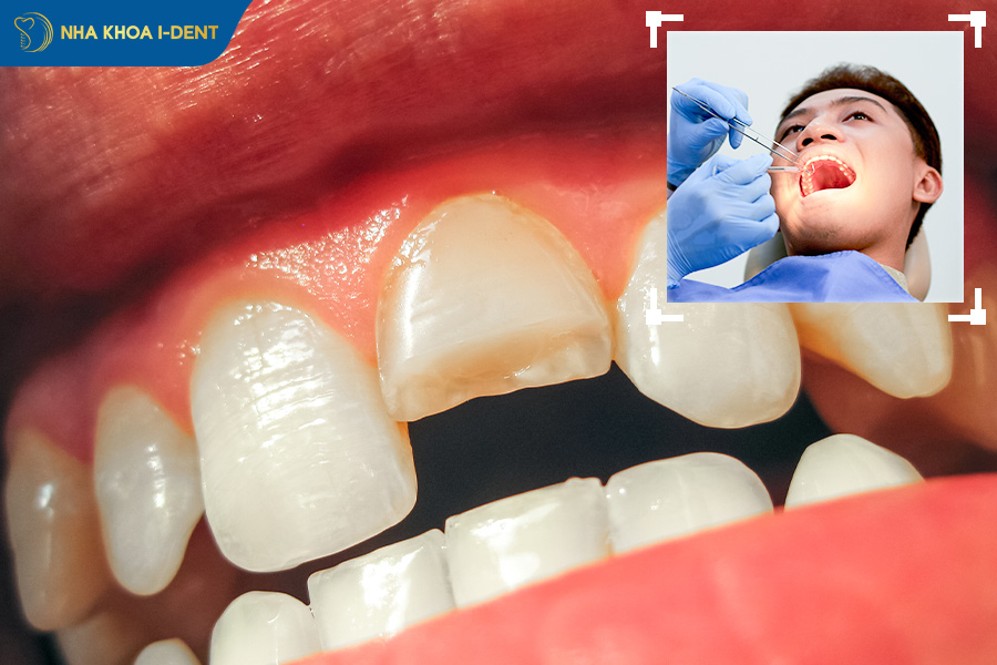 nhổ răng cửa hàm trên có nguy hiểm không