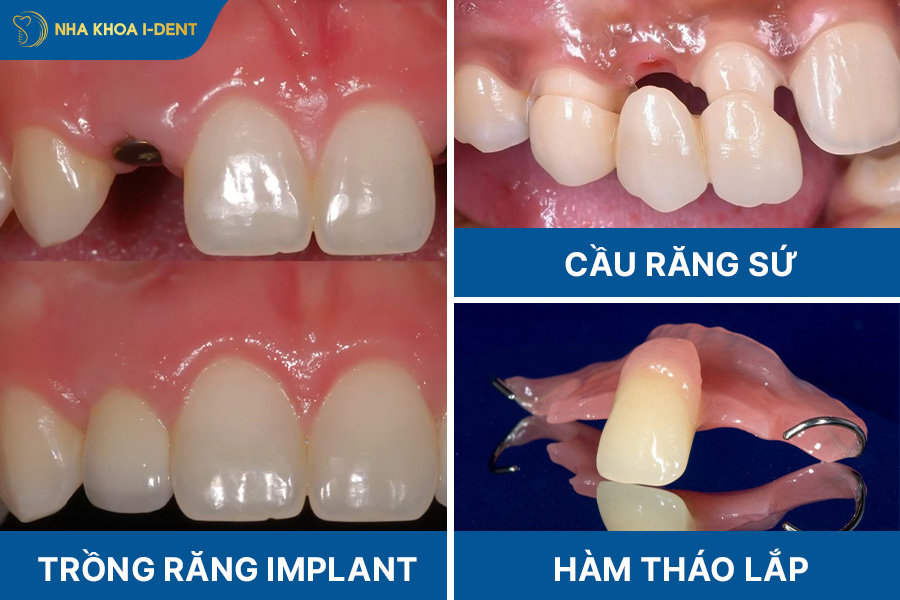 nhổ răng cửa hàm trên