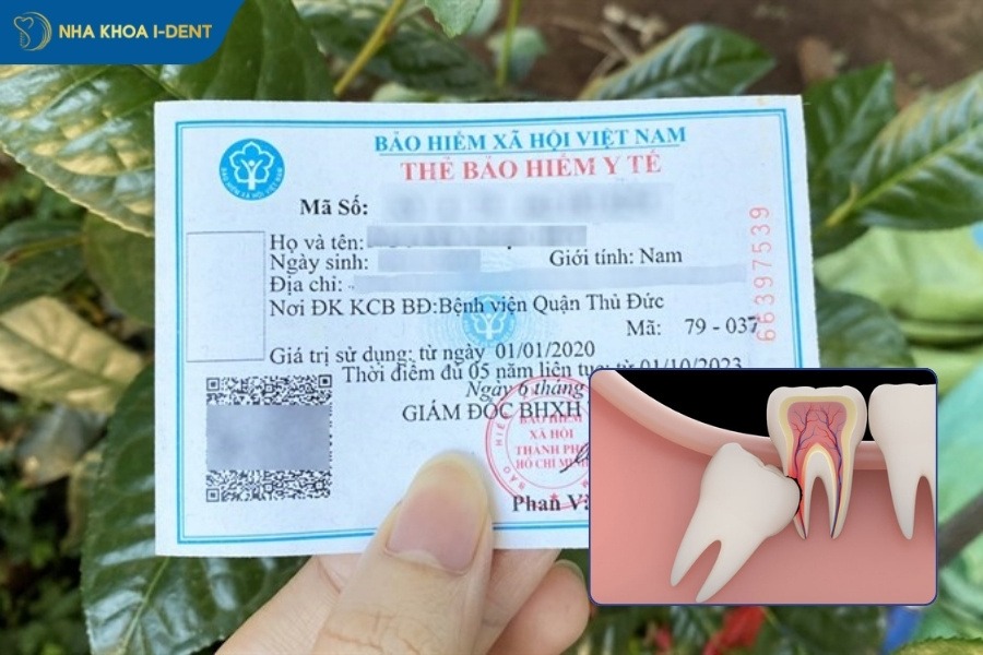 nhổ răng khôn bảo hiểm y tế ở đâu