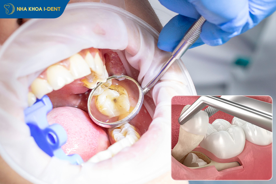 nhổ răng khôn hàm trên có nguy hiểm không