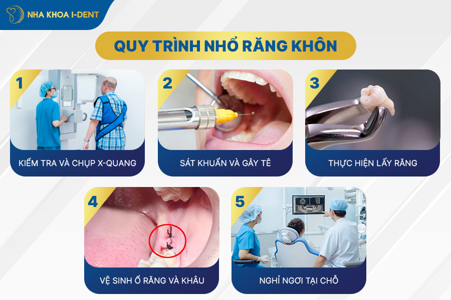 Nhổ răng khôn mọc thẳng