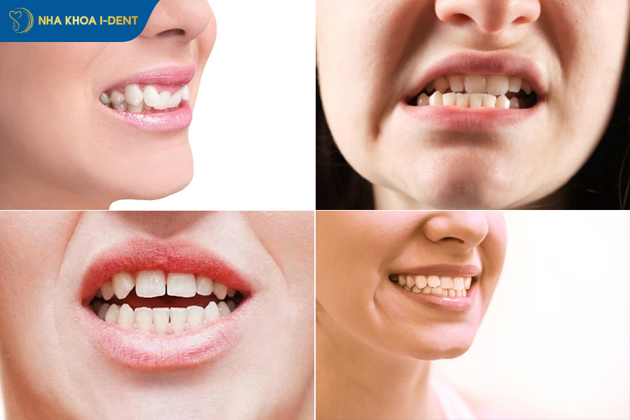 những trường hợp nên bọc răng sứ