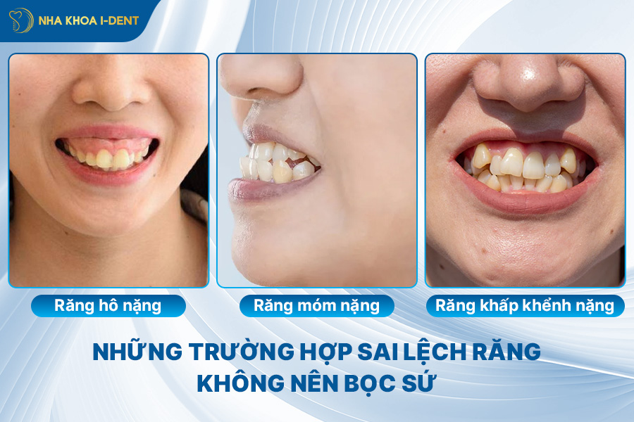 nhược điểm của việc bọc răng sứ