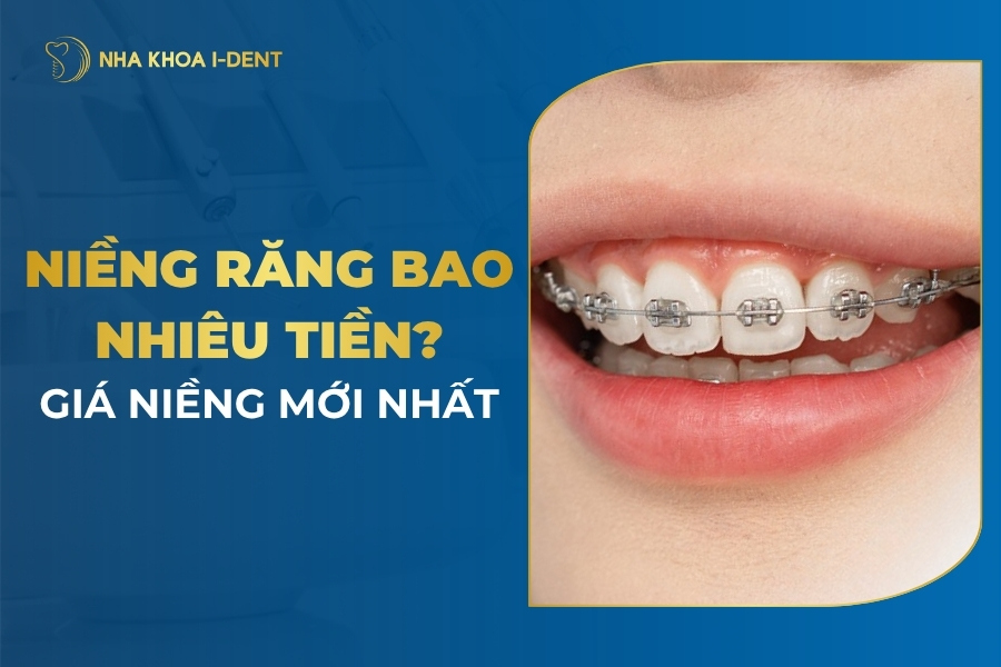 Niềng Răng Giá Bao Nhiêu? Giá Mới Nhất