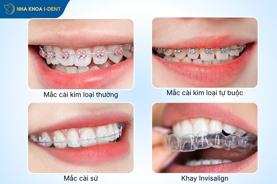 niềng răng mất bao nhiêu tiền