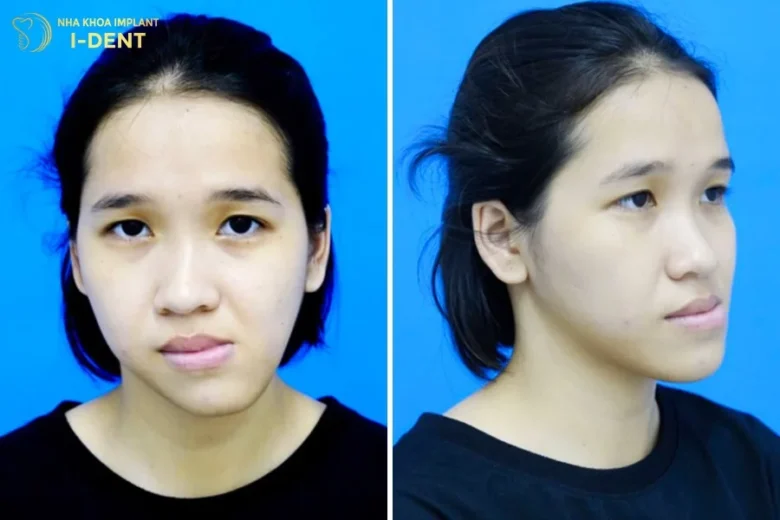 Niềng Răng Có Giúp Mặt Hết Lệch Không?