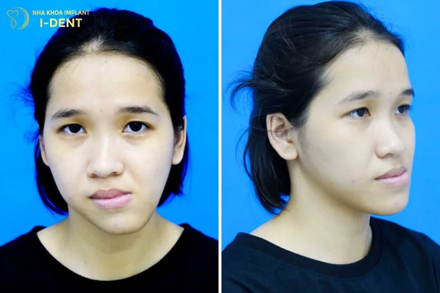 Nieng Rang Co Giup Mat Het Lech Khong 1