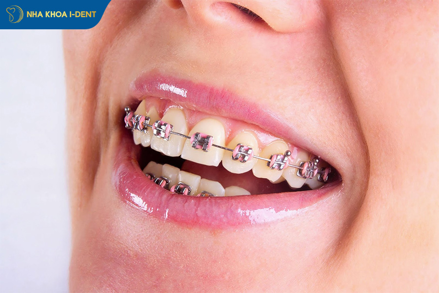 niềng răng có hết móm không