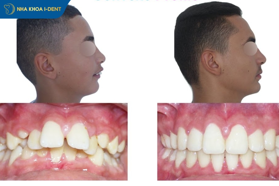 hô hàm có niềng răng được không