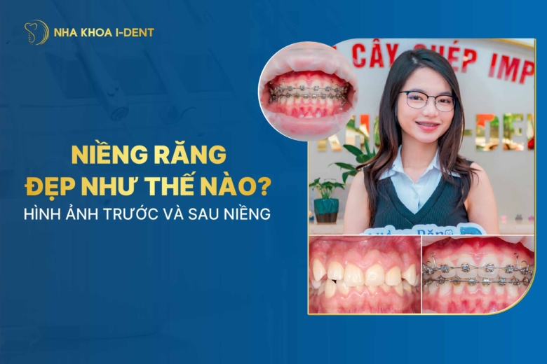 Niềng răng đẹp như thế nào? Hình ảnh trước và sau niềng