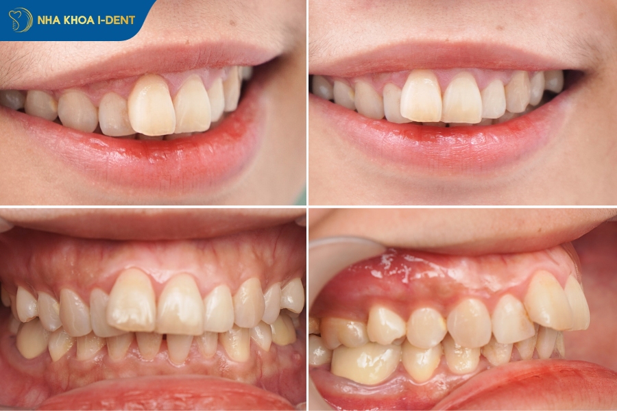 niềng răng hô nhẹ có phải nhổ răng không