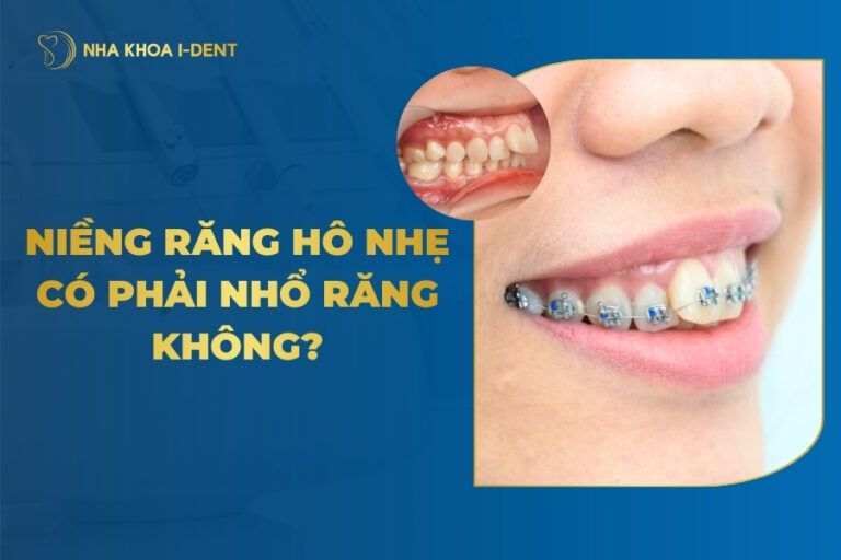Niềng răng hô nhẹ có phải nhổ răng không? Khi nào cần? Niềng răng hô nhẹ có phải nhổ răng không? Khi nào cần?