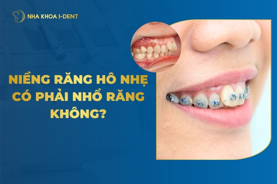 niềng răng hô nhẹ có phải nhổ răng không