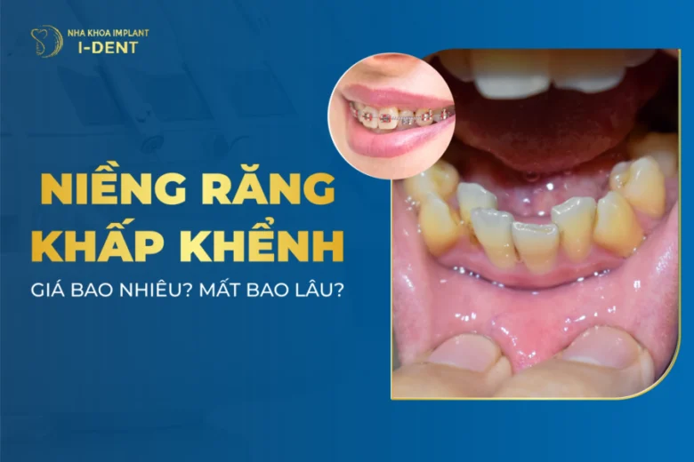 Niềng Răng Khấp Khểnh Giá Bao Nhiêu? Mất Bao Lâu?