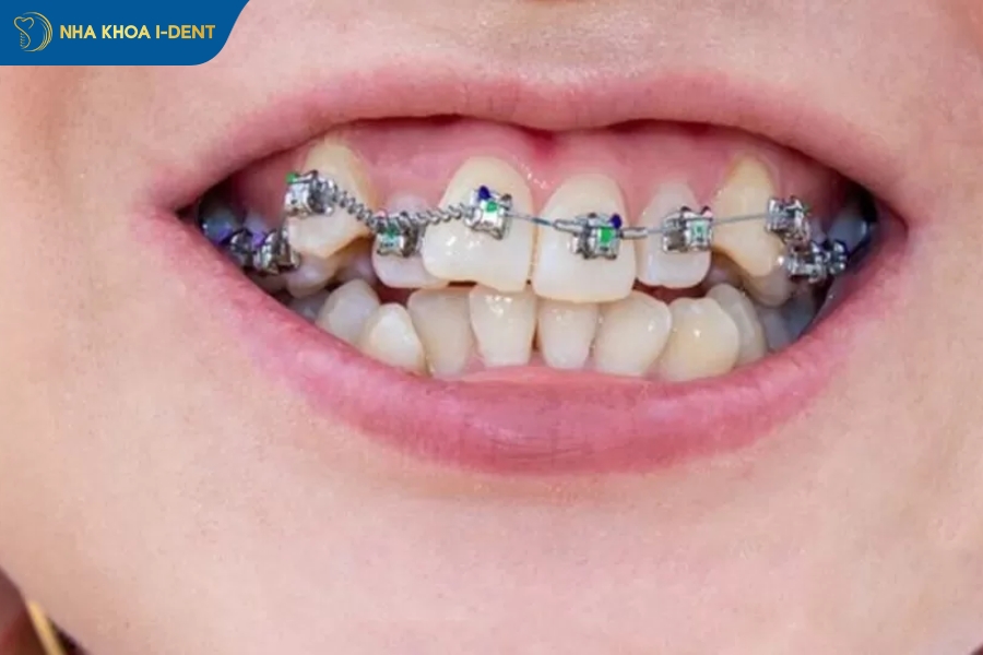 niềng răng không nhổ răng