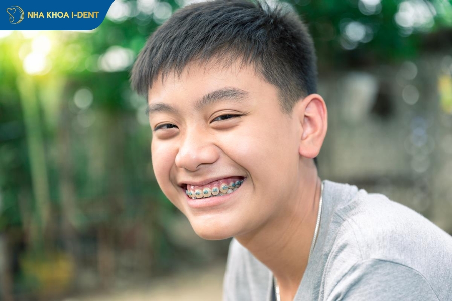 niềng răng không nhổ