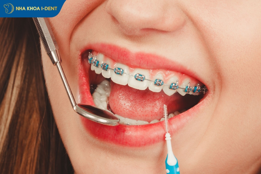 niềng răng không nhổ răng khôn có được không