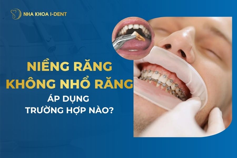 niềng răng không nhổ răng có hiệu quả không