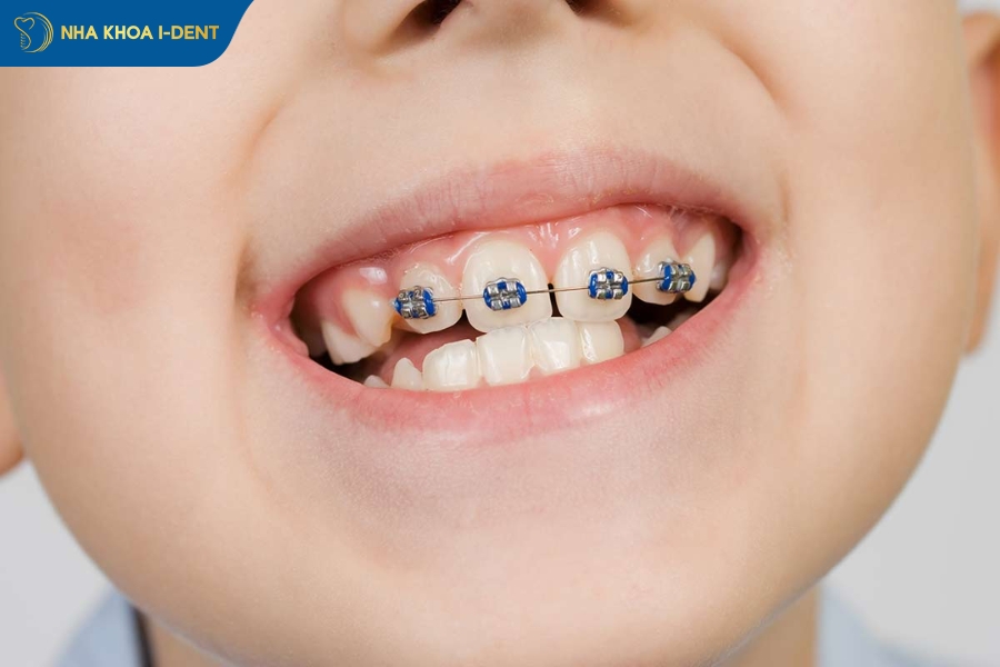 niềng răng không nhổ răng được không