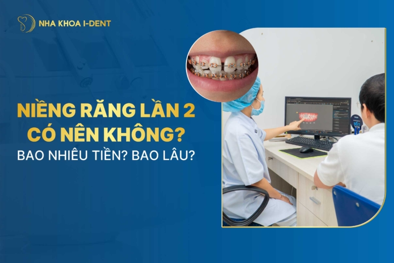 Niềng răng lần 2 có nên không? Bao nhiêu tiền? Bao lâu?