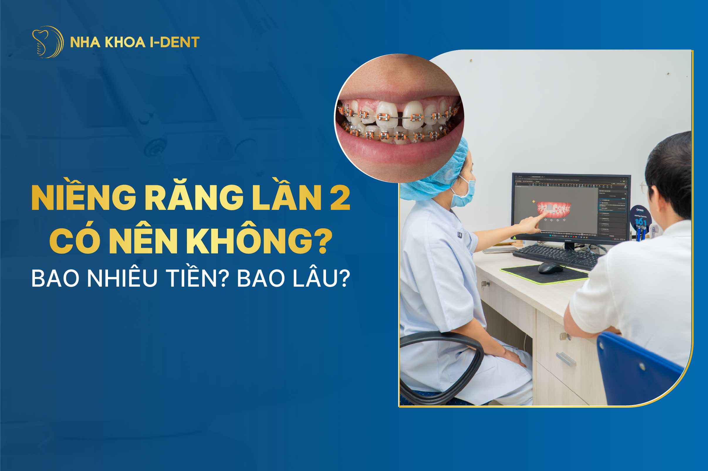 Niềng răng lần 2 có nên không? Bao nhiêu tiền? Bao lâu?
