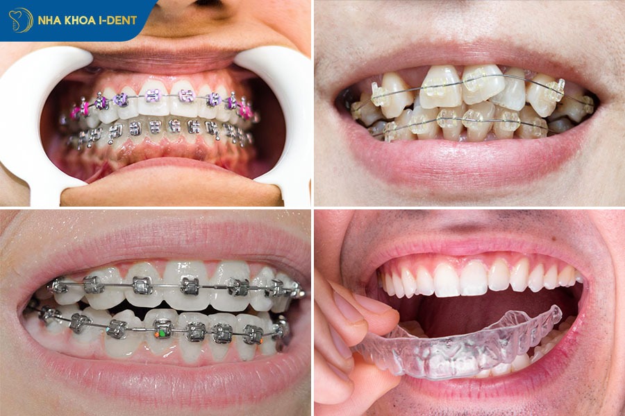 20 tuổi niềng răng bao lâu