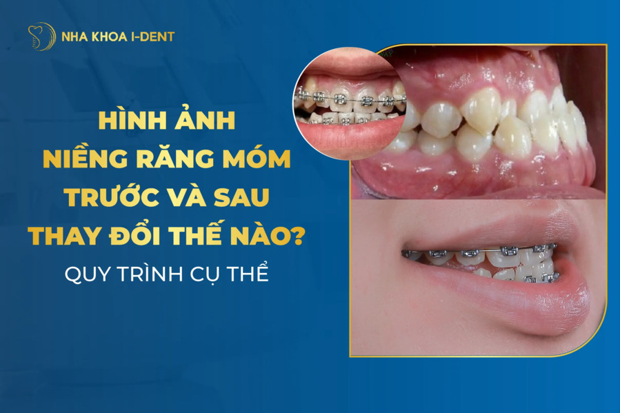 niềng răng móm trước và sau