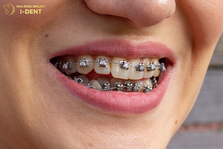 niềng răng titan