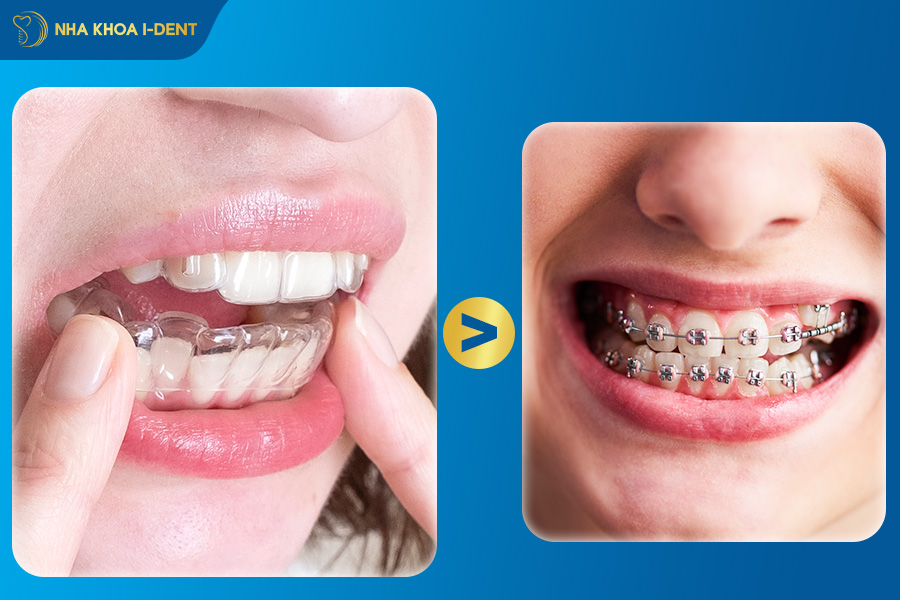 nên niềng răng trong suốt hay mắc cài
