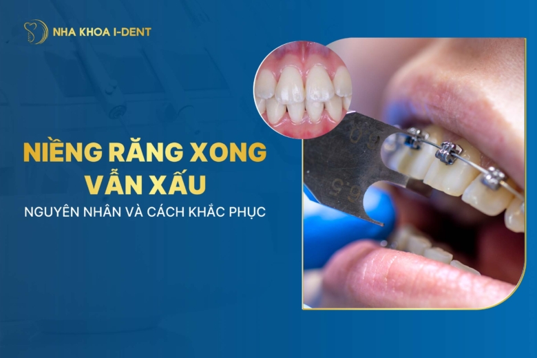 Niềng răng xong vẫn xấu: Nguyên nhân và cách khắc phục