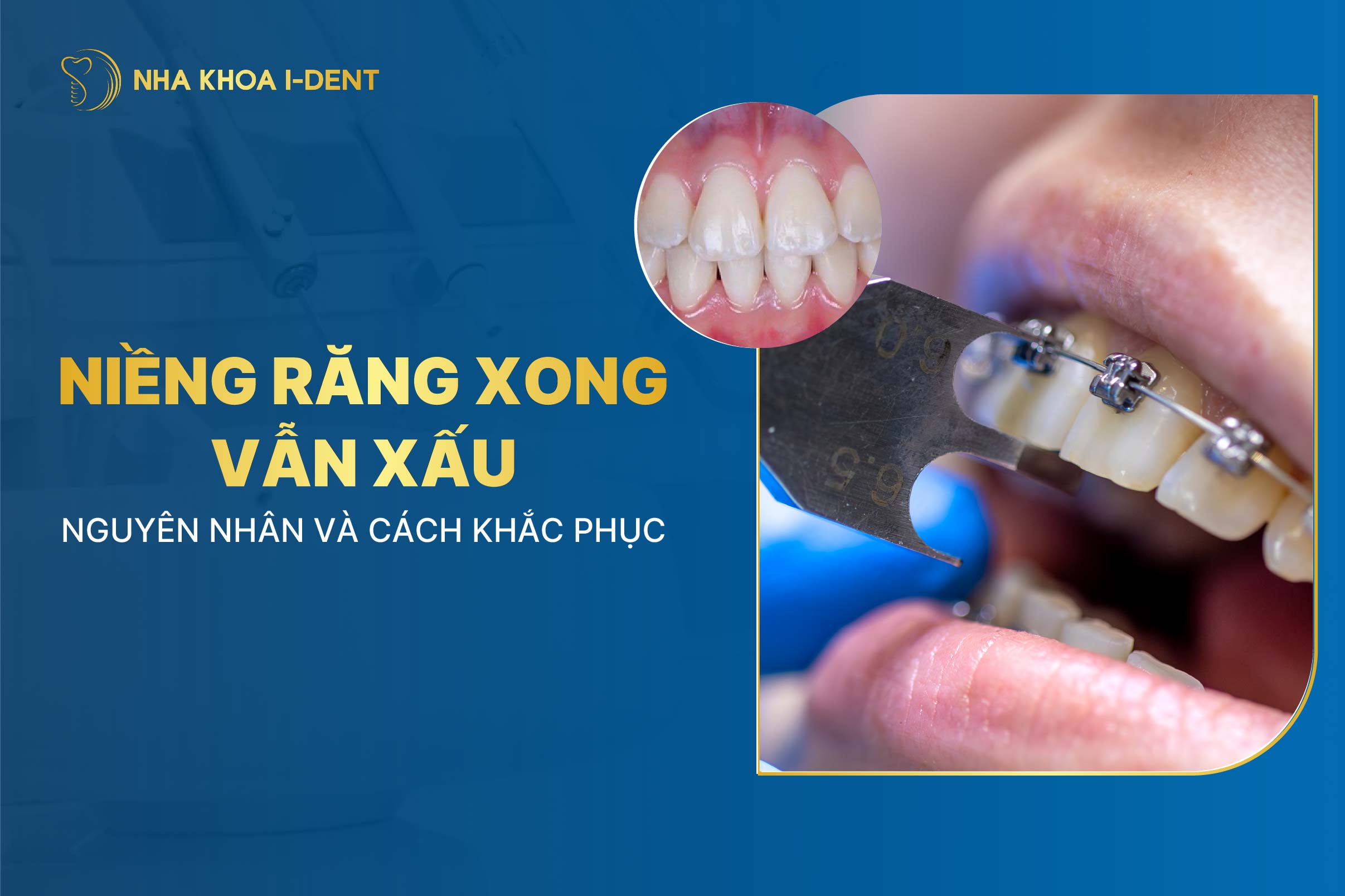Niềng răng xong vẫn xấu: Nguyên nhân và cách khắc phục
